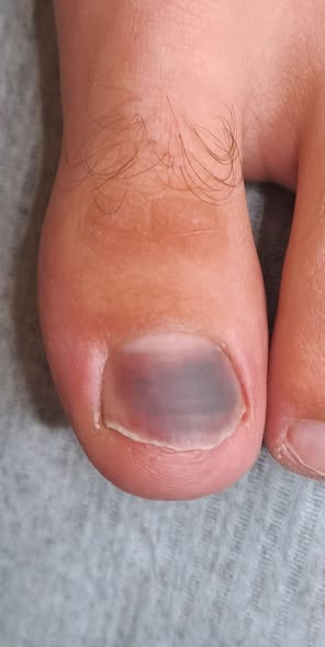 zdrowa Stopa usuwanie krwiaka przed